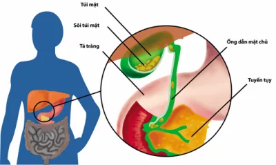 Sỏi mật và những điều cần biết